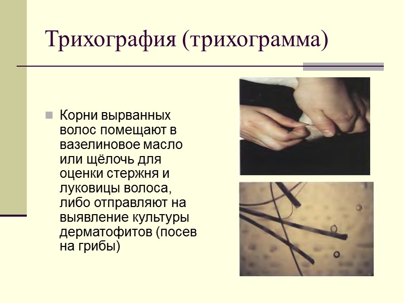 Трихография (трихограмма)    Корни вырванных волос помещают в вазелиновое масло или щёлочь